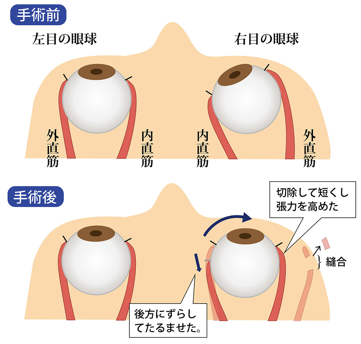 スマホの見過ぎで急性内斜視（スマホ内斜視）になる?!