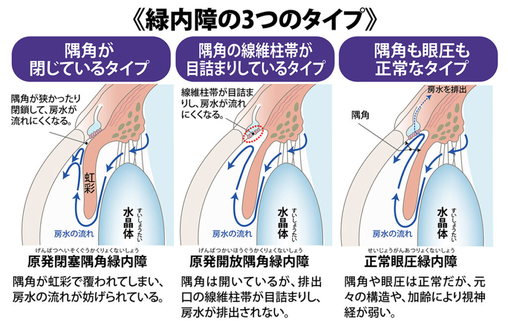 イラストで詳細に解説。緑内障とは!