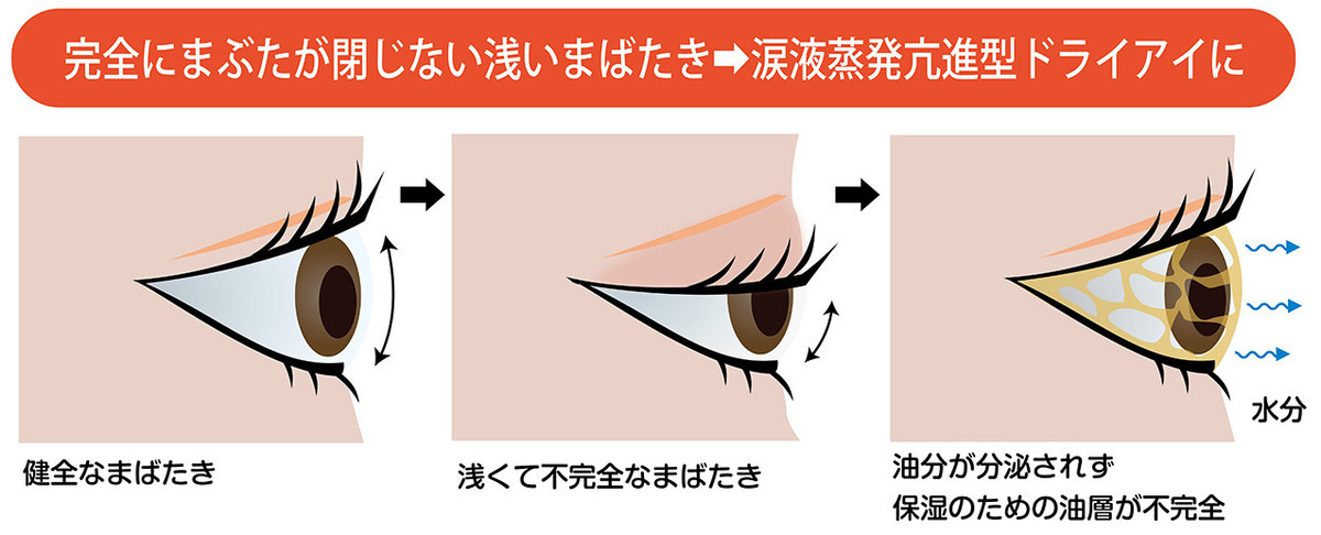 1日何度も目薬使っているのに良くならない。原因と対策は!