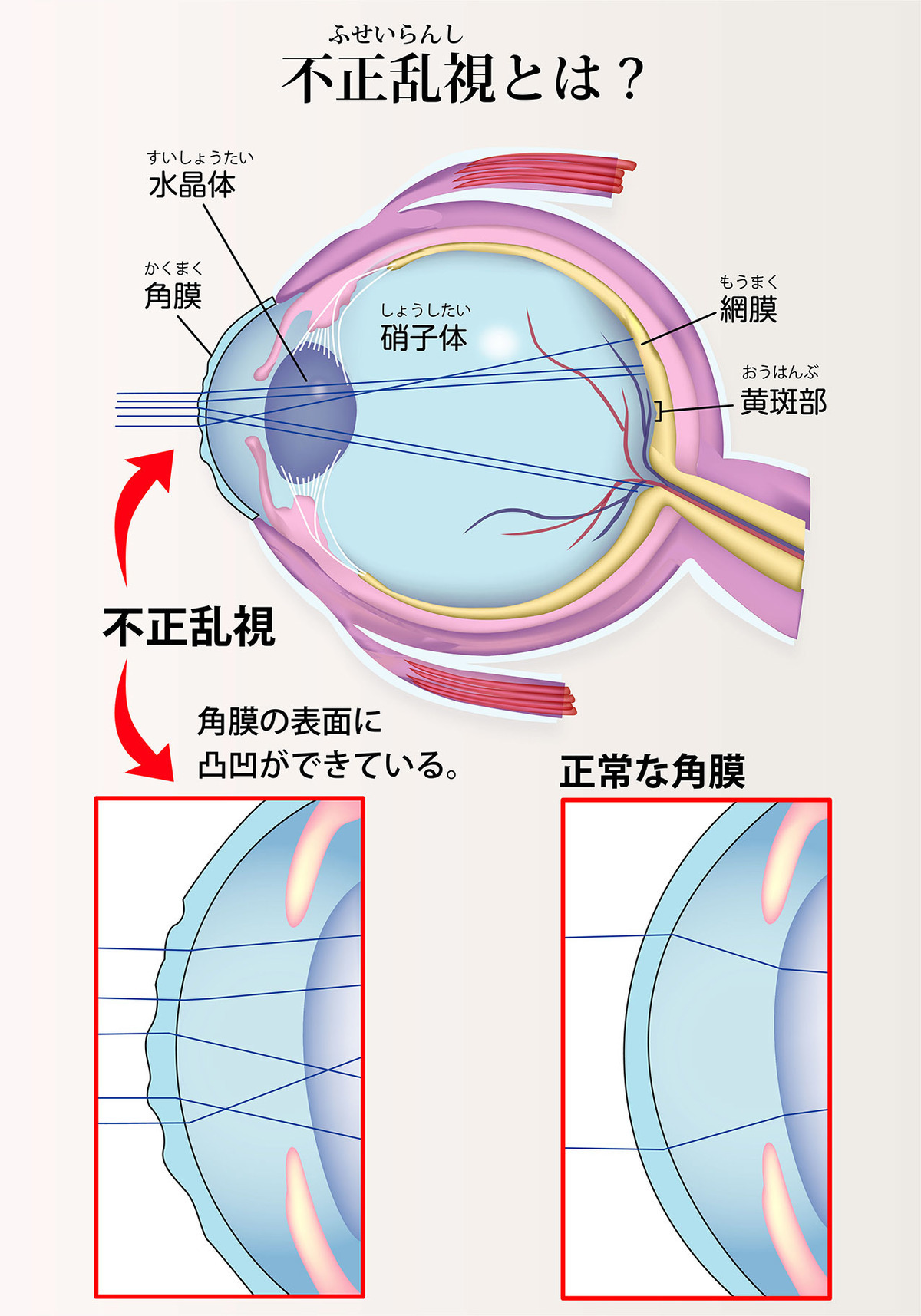 イラストで詳細に解説。乱視とは?