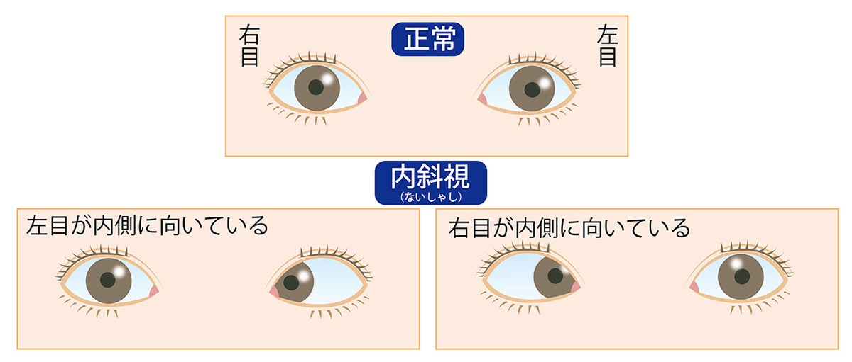 スマホの見過ぎで急性内斜視（スマホ内斜視）になる?!